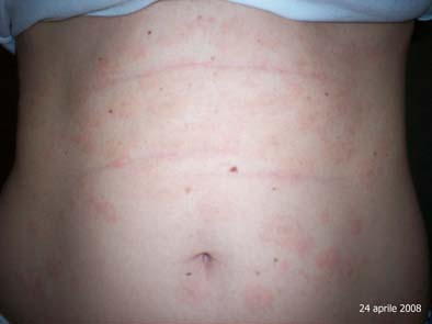 pytiriasis